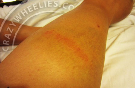 bruised leg